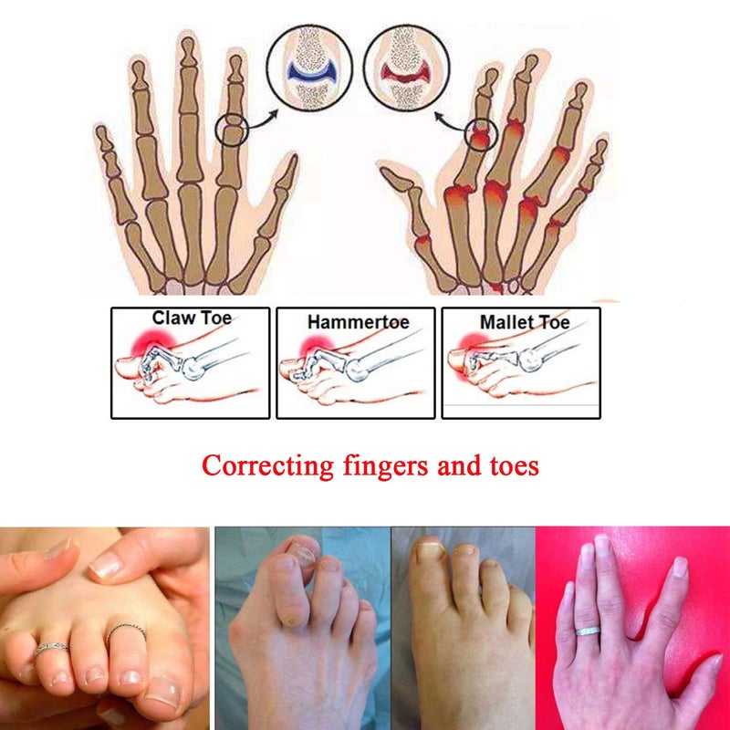 Yimanduo 6 Pcs Broken Toe Separator Wrap Hammer Toe, Toe Straightener, Cushioned Bandages Toe Splint Wraps Separator for Broken Injured Finger Hammer Toe - Image 3